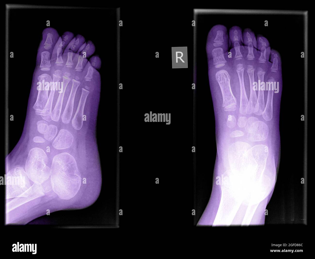 Foot X-ray of a 10 year-old male patient (white arrow indicates