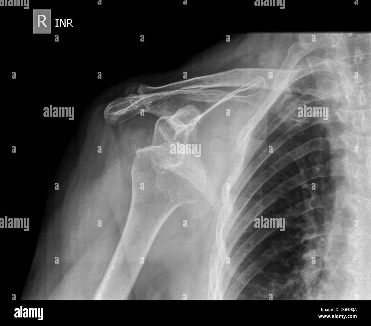 x-ray Dislocated shoulder on a 75 year old female Stock Photo