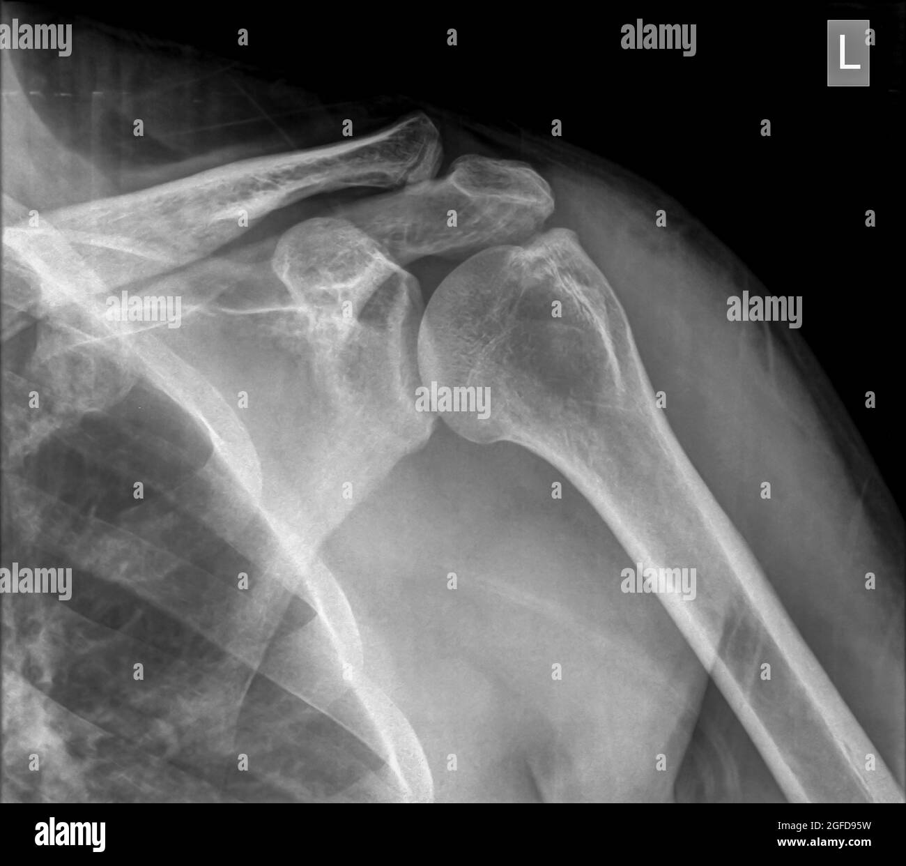 Shoulder x-ray of a 40 year old male patient with a fractured clavicle front view Stock Photo