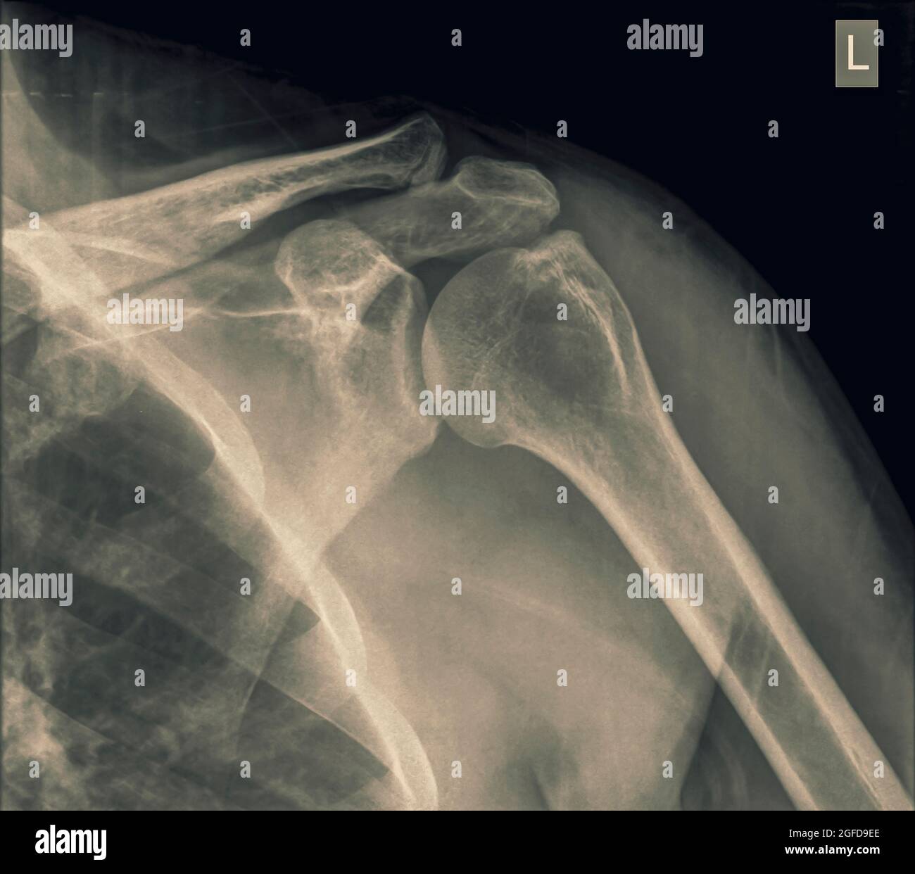 Shoulder x-ray of a 40 year old male patient with a fractured clavicle front view Stock Photo