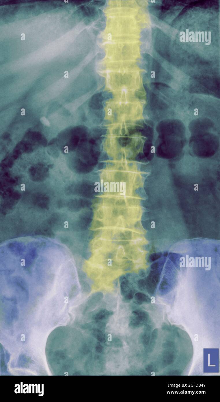 Human Lumbar Spine x-Ray Front View 77 year old patient Stock Photo