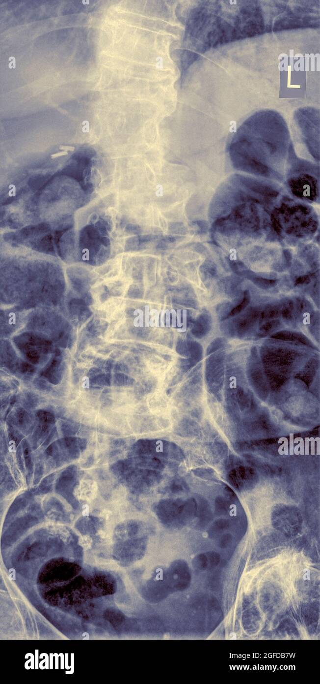 Lower back pain. Human Lumbar Spine x-Ray Front View Female 75 year old Stock Photo