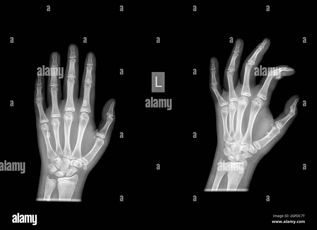 Radius Distal fracture on a 13 year old female patient Stock Photo Alamy