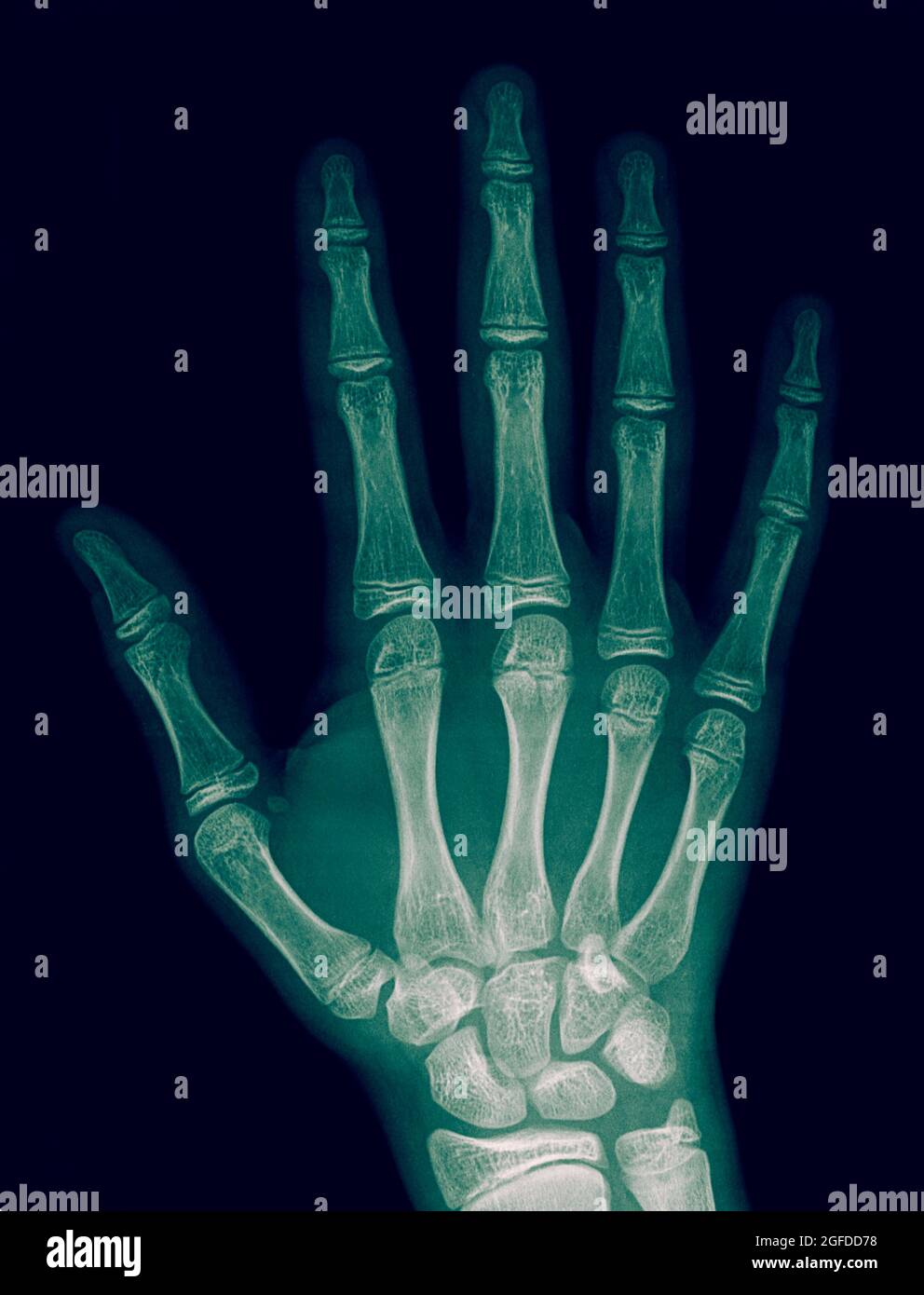 x-ray of the right hand of a 14 year old male with a fracture in the number 3 metacarpal bone Stock Photo