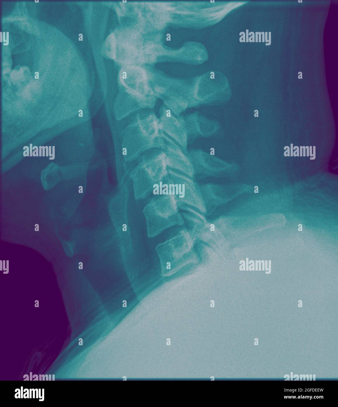 X-ray of a human Cervical spine Side View Stock Photo