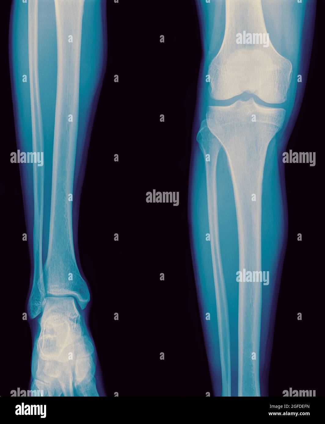 x-ray of the right knee of a 42 year old male no fracture or dislocation shown Stock Photo