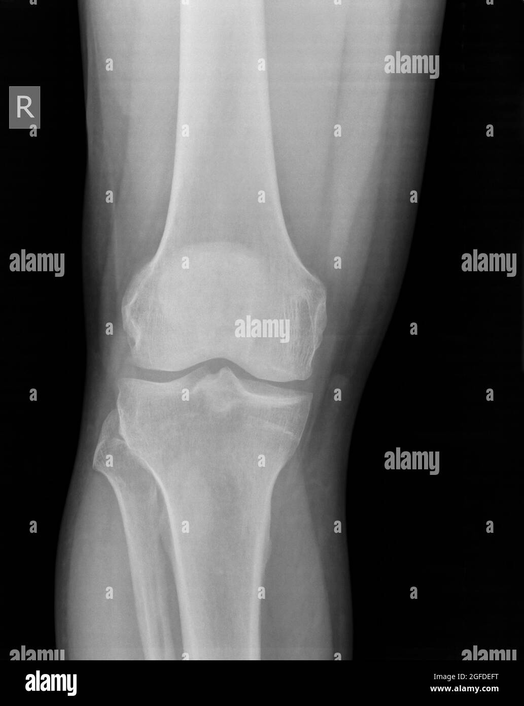 Knee x-ray of a 44 year old male patient front view Stock Photo