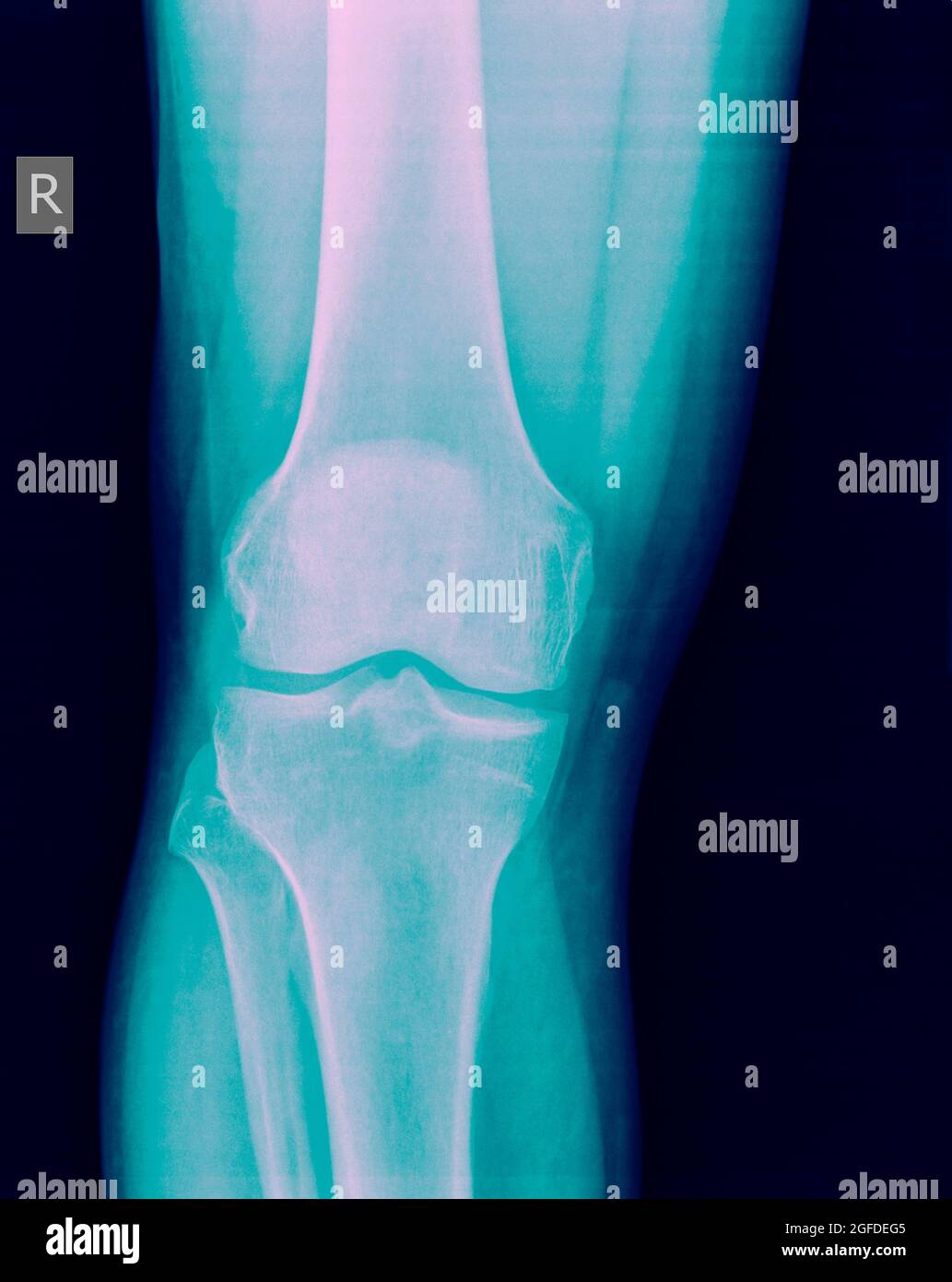 Knee x-ray of a 44 year old male patient front view Stock Photo