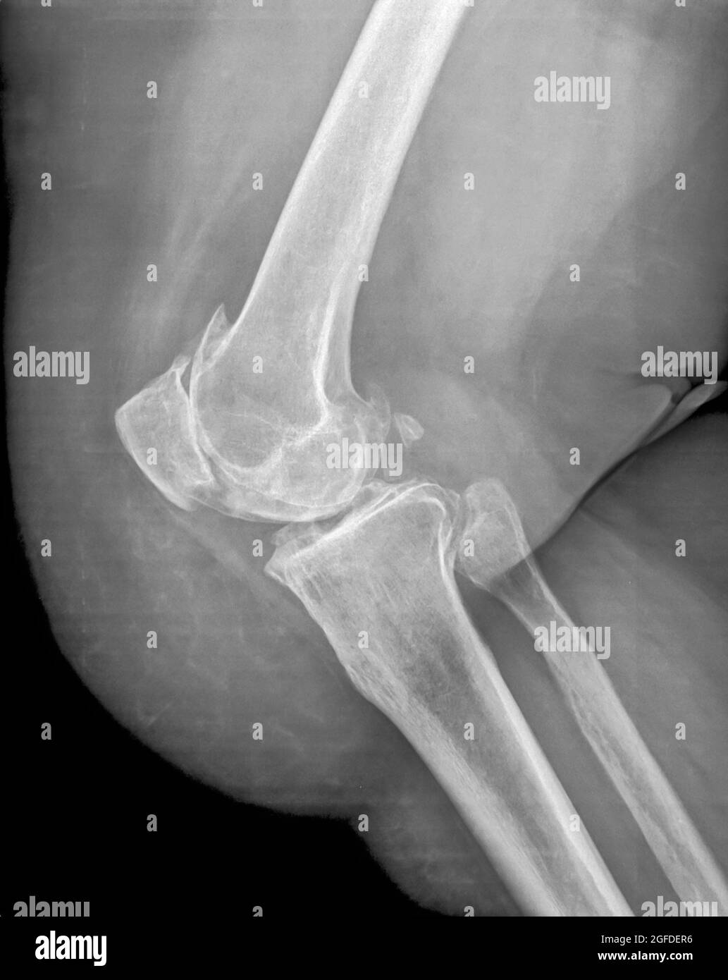 x-ray of the right knee of a 65 year old male Stock Photo