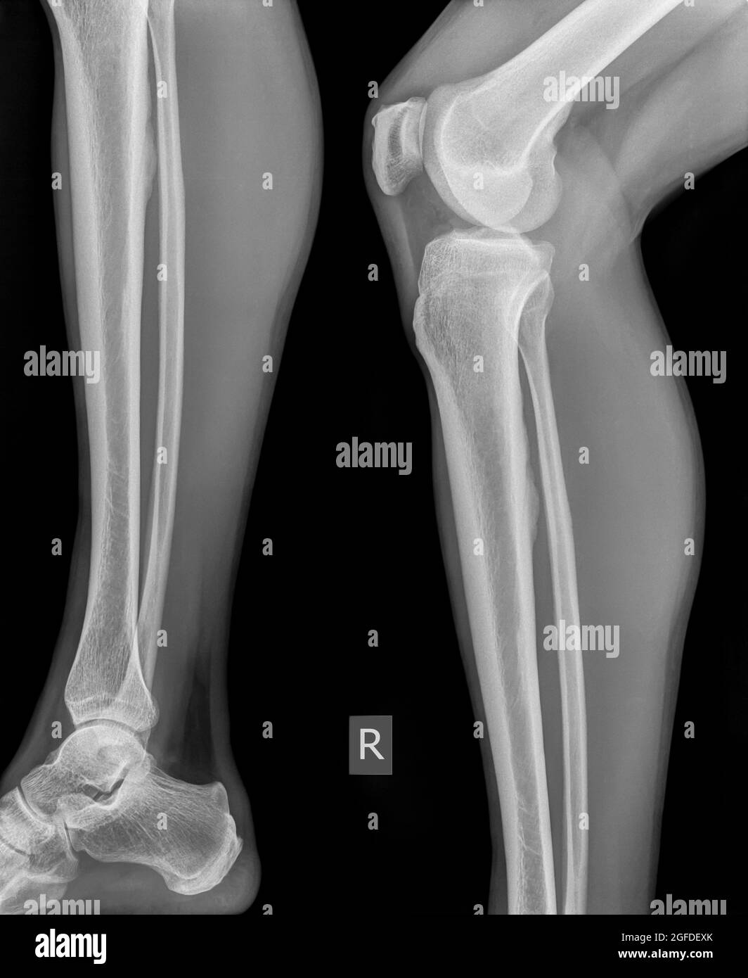 x-ray of the right knee of a 42 year old male no fracture or dislocation shown Stock Photo