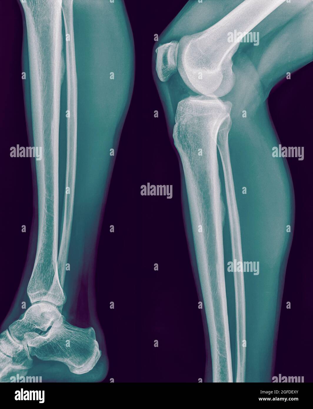 x-ray of the right knee of a 42 year old male no fracture or dislocation shown Stock Photo