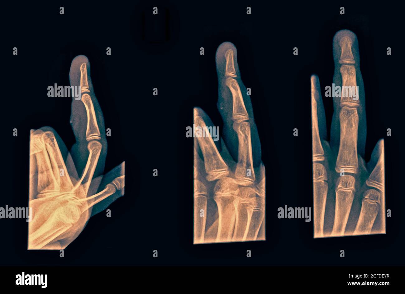 3 views of the forth finger right hand after suffering Contusion with