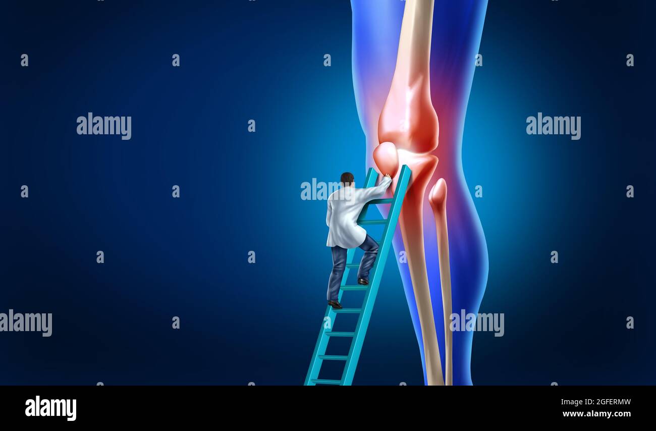 Knee pain care with the anatomy of a skeleton leg and showing the inside inflamation as painful joint that needs surgery by an orthopedic surgeon. Stock Photo