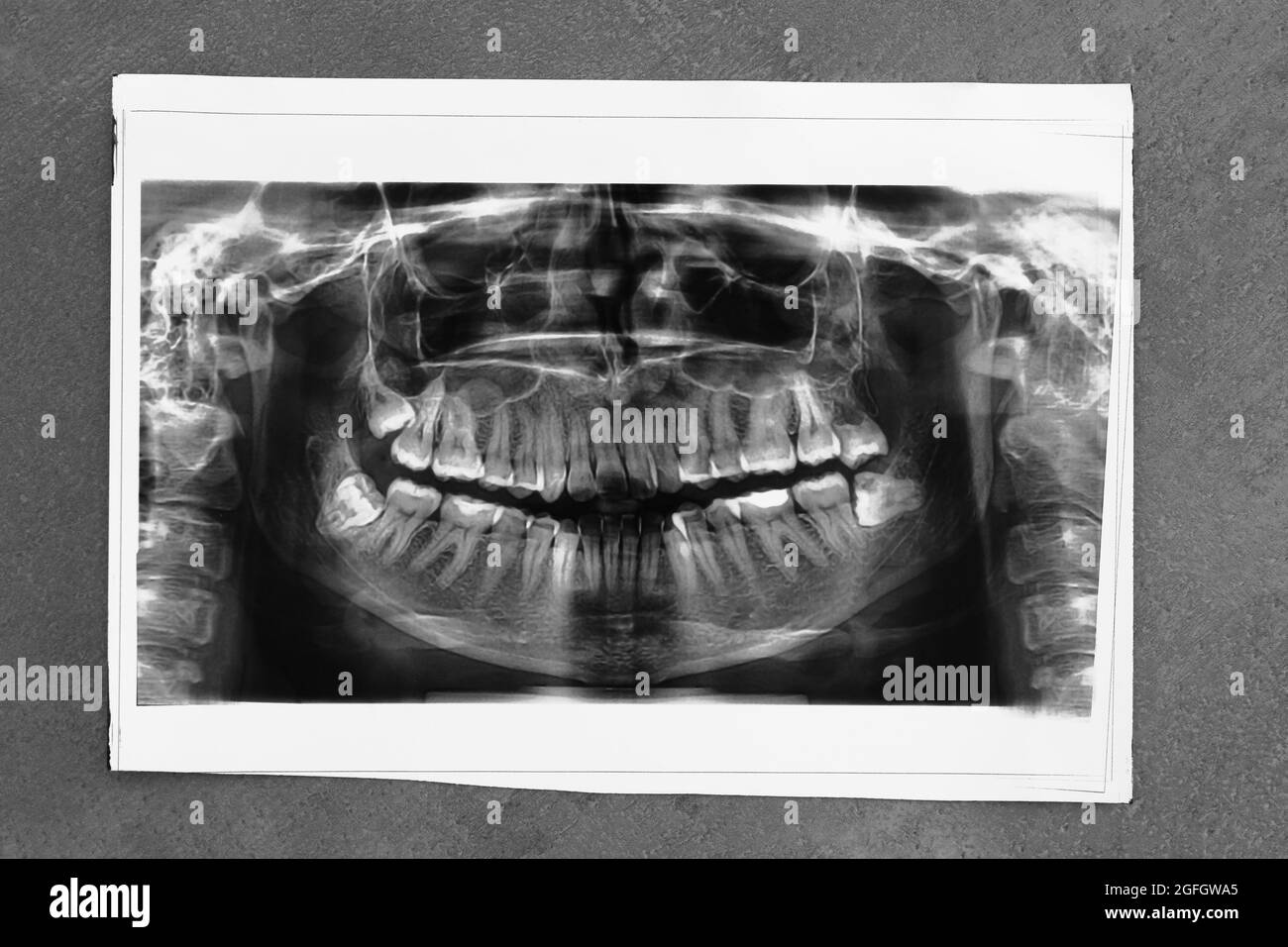 Panoramic dental XRay Stock Photo Alamy