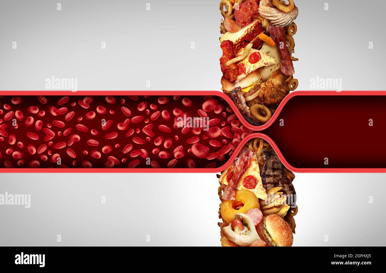 Blood circulation and cholesterol as fatty food causing a clogged artery or human vein as greasy fast food narrowing of arteries blocking blood. Stock Photo