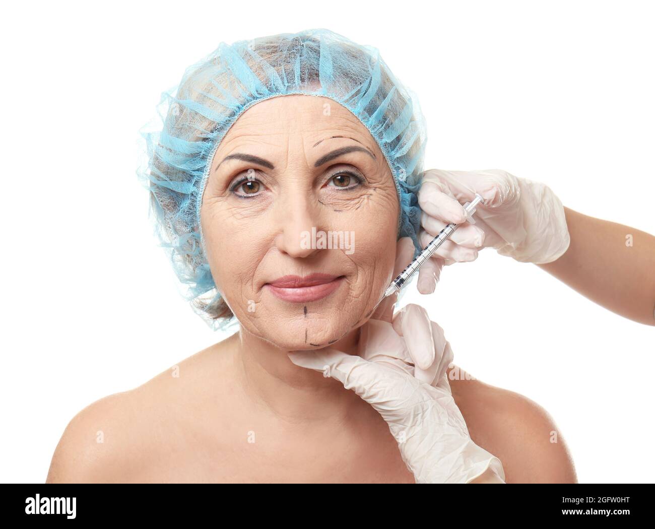 Hyaluronic acid injection for facial rejuvenation procedure Stock Photo Alamy