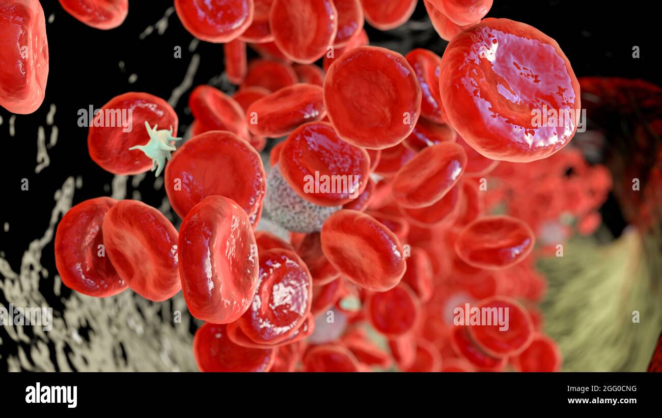 Polycythemia vera hires stock photography and images Alamy