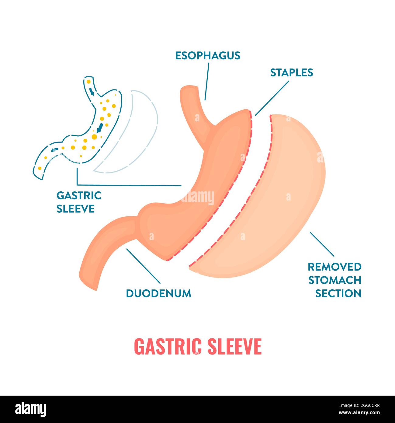 Gastric sleeve bariatric surgery, illustration. Stock Photo