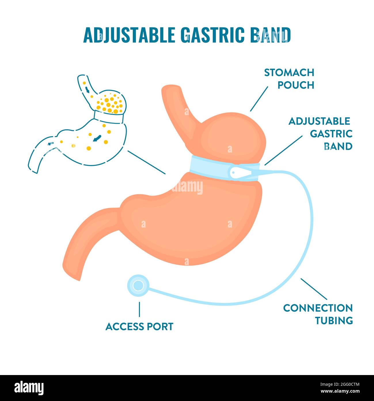 Adjustable gastric band bariatric surgery, illustration. Stock Photo