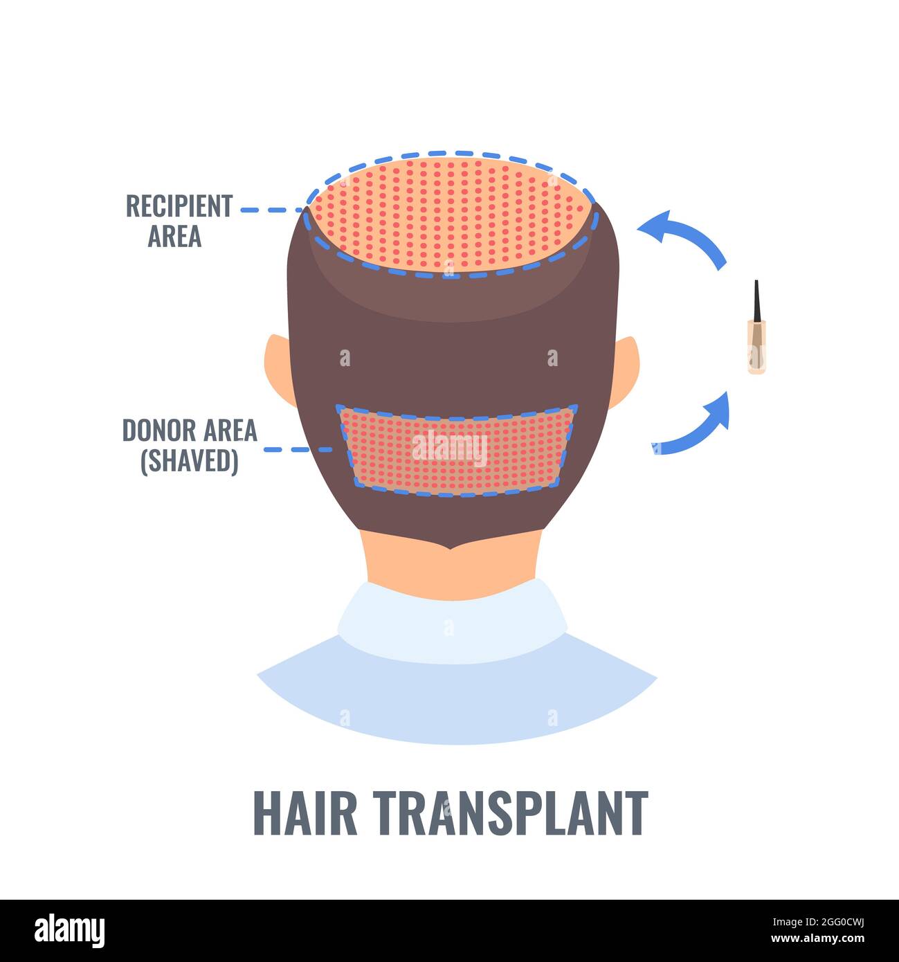 Hair transplantation, illustration. Follicular unit extraction (FUE) hair transplant donor site and recipient area. Stock Photo