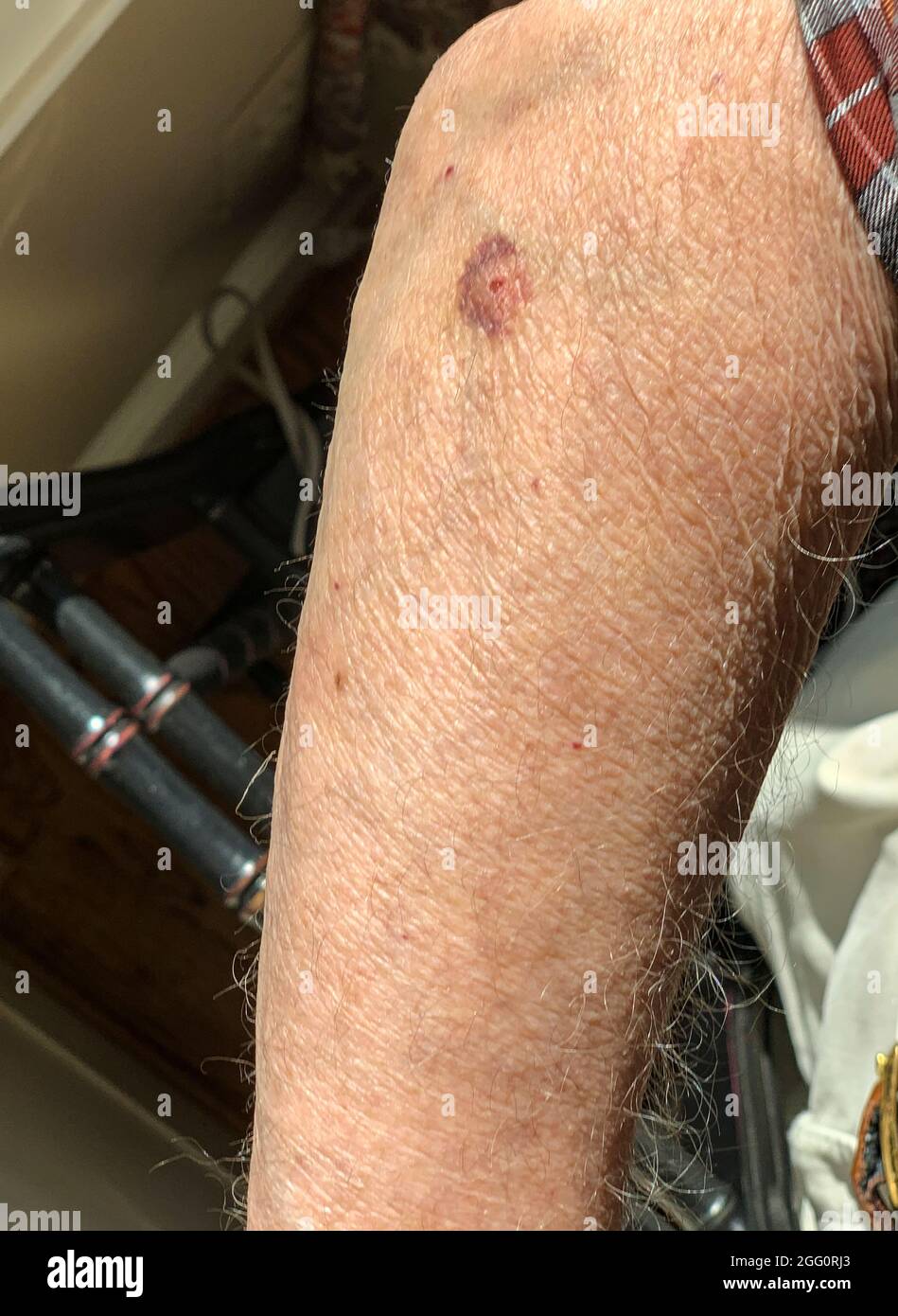 Bullseye Rash on Upper Arm, Sign of Lyme Disease. Stock Photo