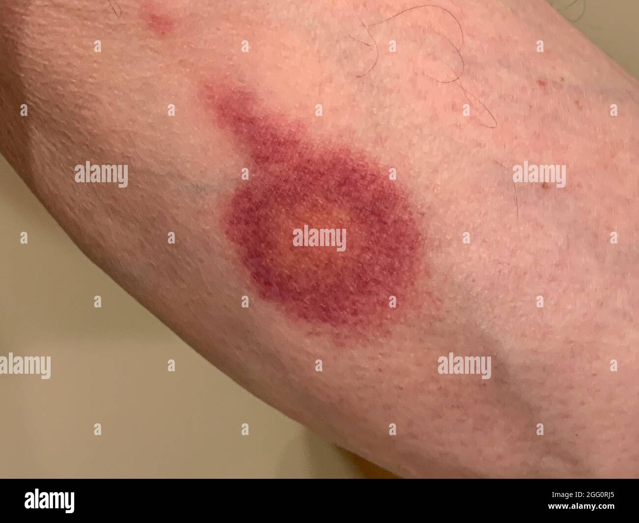 Bullseye Rash on Lower Leg, Six days after bite. Sign of Lyme Disease. Stock Photo