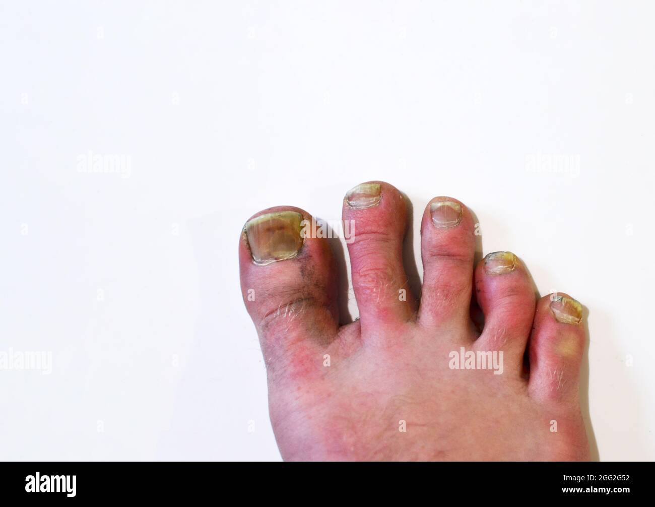 Fungal nail infection on male toe. Fungus on the toes of a diseased man