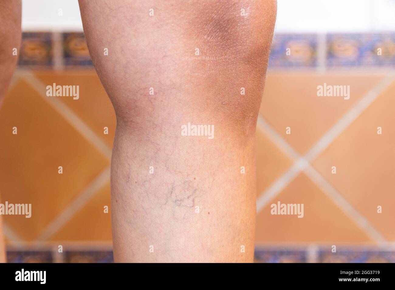 Adult woman's leg with varicose veins Stock Photo