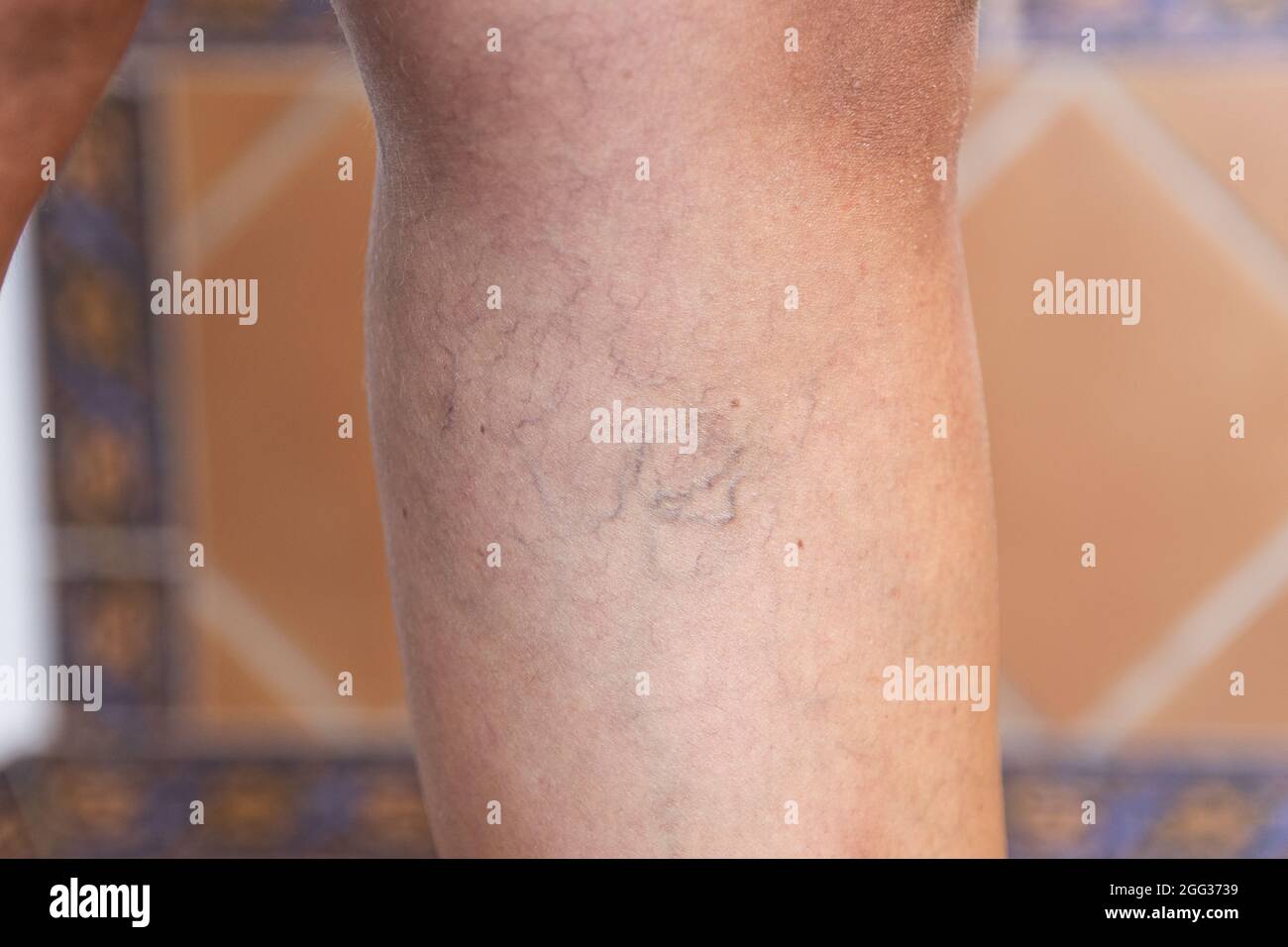 Adult woman's leg with varicose veins Stock Photo