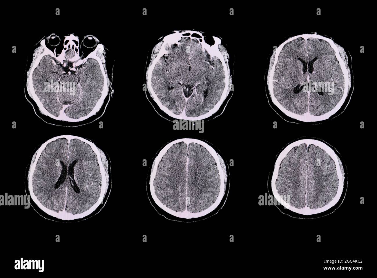 CT brain scan of a patient with Streptococcus suis meningitis showing leptomeningeal enhancing along bilateral parietal cortical sulci. Stock Photo