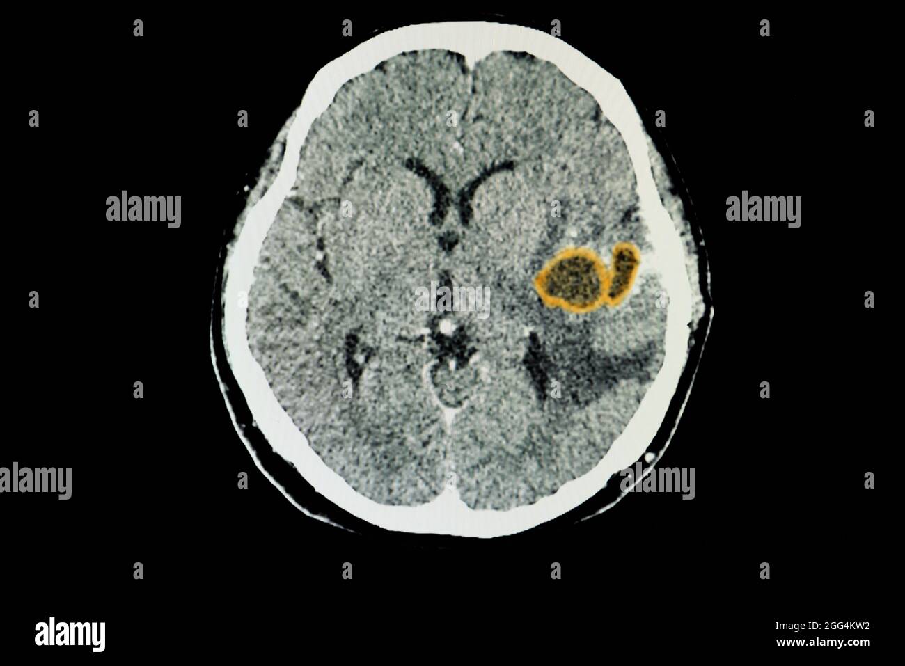 A CT brain scan of a patient with large brain abscesses in her left