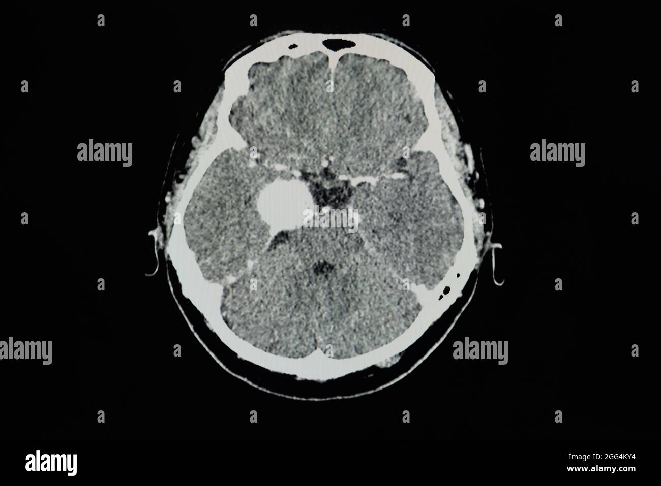 CT brain scan with contrast of a patient showing 3.8 cm rim enhancing lesion at right cavernous sinus with internal calcification most likely menigiom Stock Photo