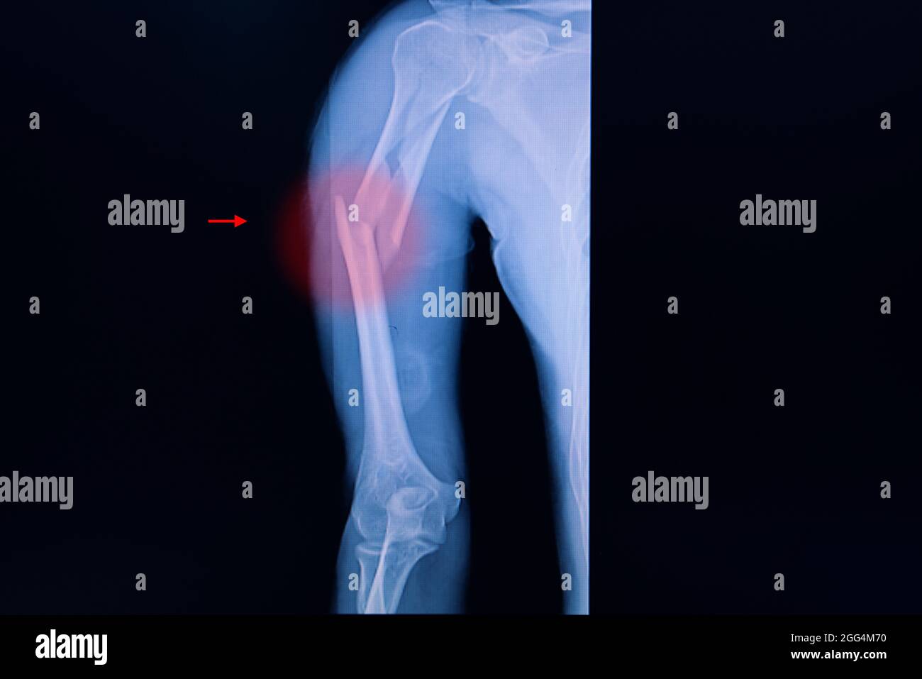 Xray film of an arm of a patient showing humerus fracture. Stock Photo
