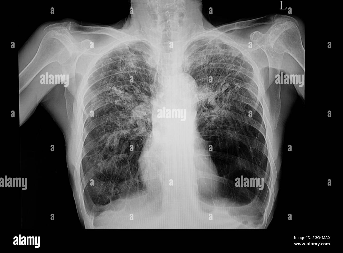 Emphysematous changes of lung black and white stock photos images alamy