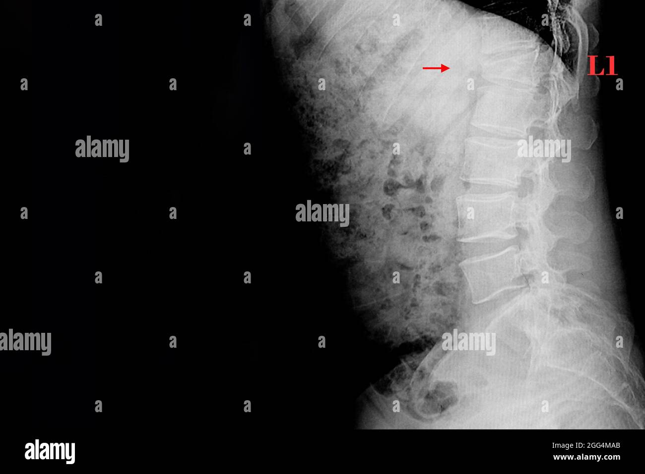 Xray image of lumbar spines of a patient showing compression fracture of L1 lumbar spine. Stock Photo