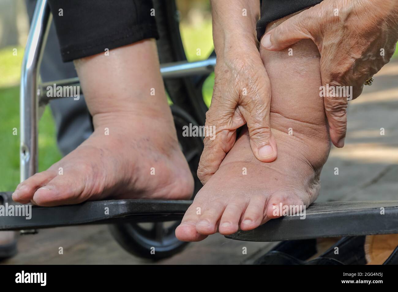 Elderly woman swollen feet press test on wheelchair Stock Photo Alamy