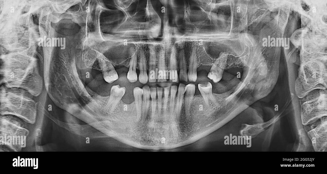 Panoramic dental X-ray close up. Case of Adentia Stock Photo