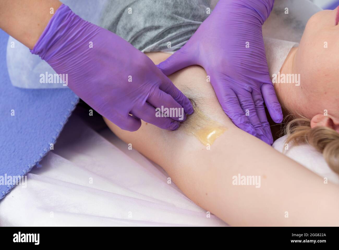 Sugaring hair removal concept. Process depilation of underarm girl with sugar paste in spa salon, white background. Stock Photo