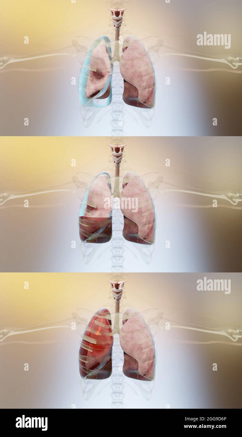 3d Illustration of Pneumothorax, Hemothorax and Hemopneumothorax, Normal lung versus collapsed, symptoms of pneumothorax, pleural effusion, empyema, 3 Stock Photo
