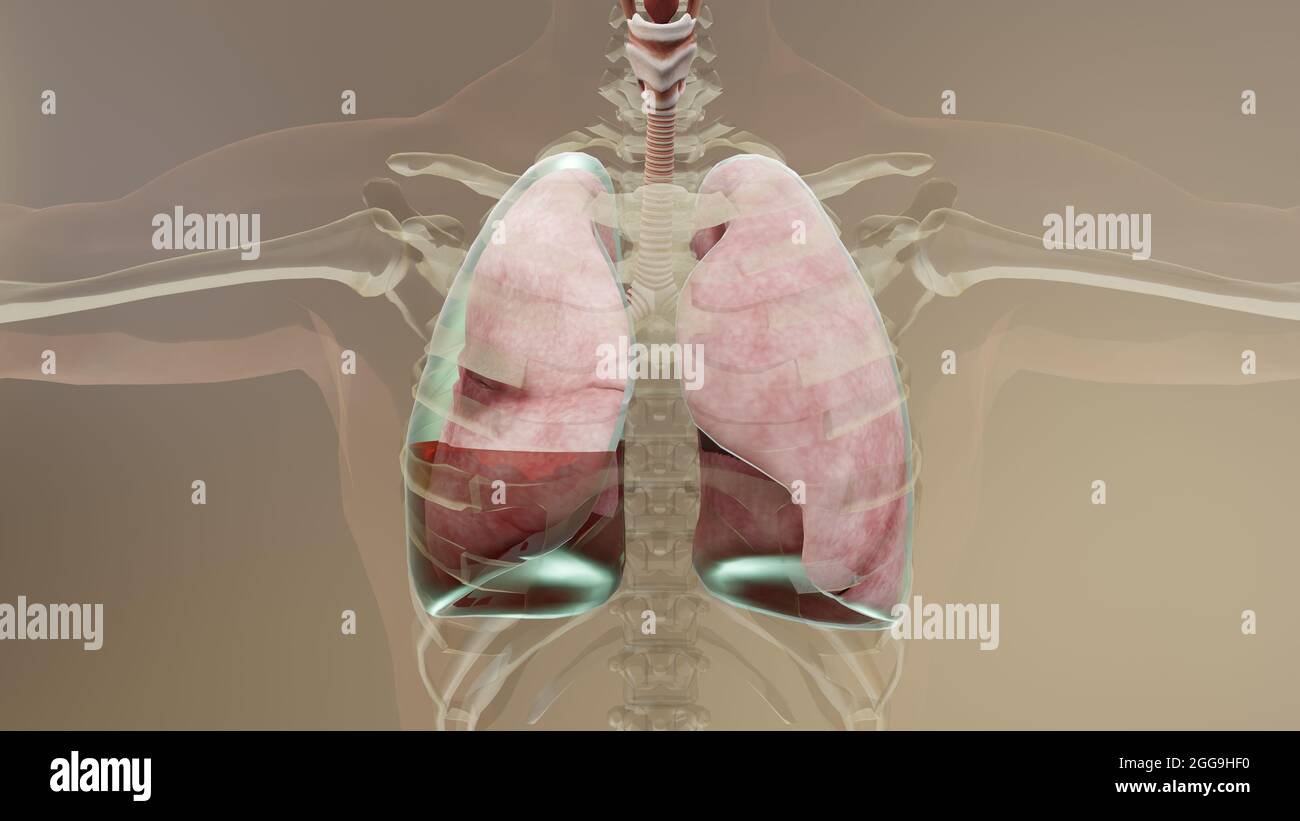 3d Illustration of Hemopneumothorax, Normal lung versus collapsed, symptoms of Hemopneumothorax, pleural effusion, empyema, complications Stock Photo