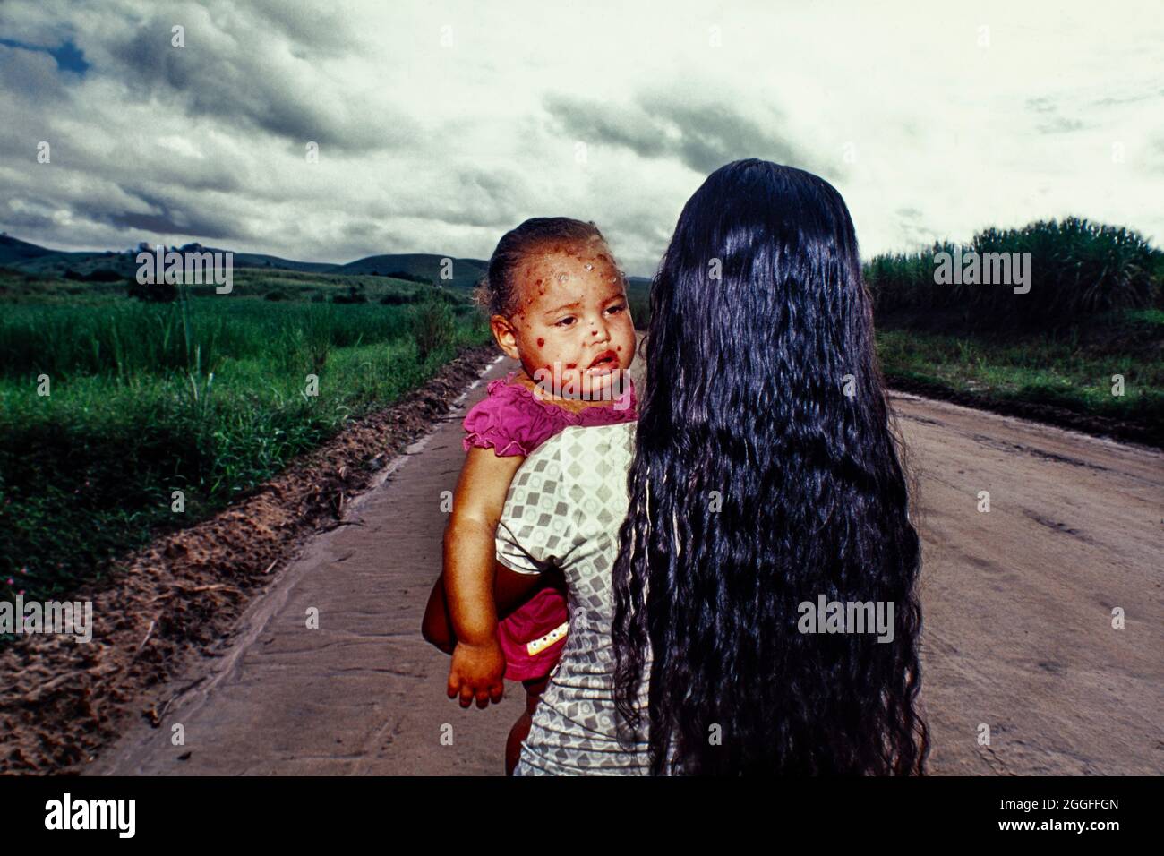 Woman takes 1-year old baby suffering from skin ulcer to hospital crossing a sugarcane plantation. Stock Photo