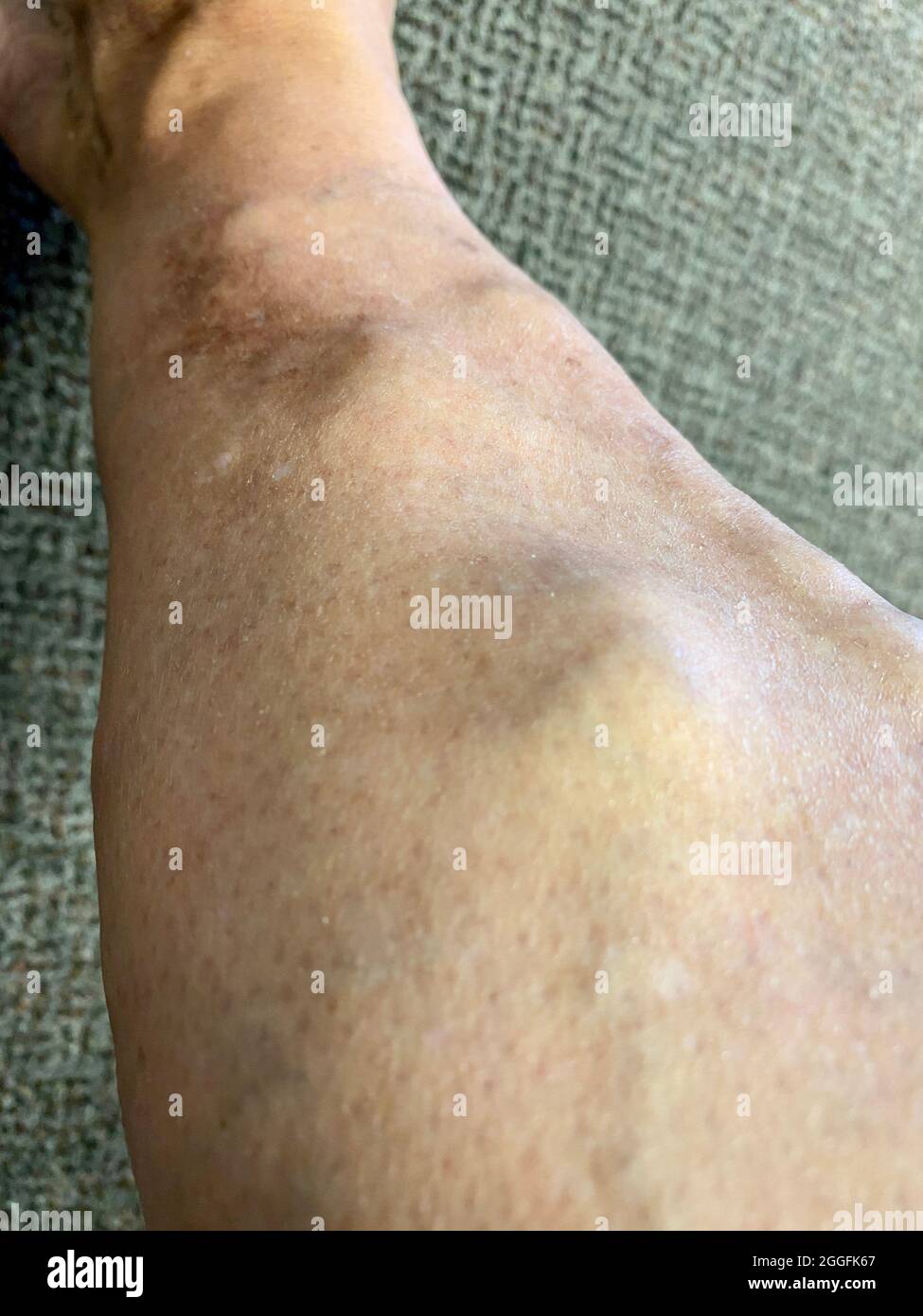 Varicose veins on the lower leg of a female in her late 40's. Stock Photo