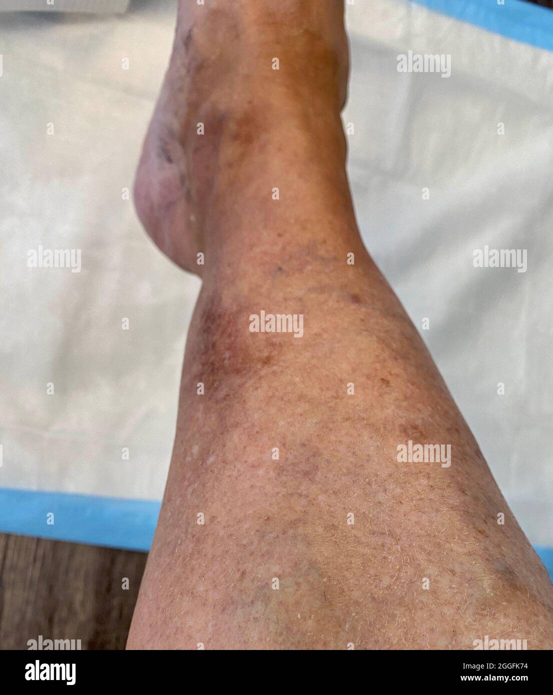 Varicose veins on the lower leg of a female in her late 40's. Stock Photo