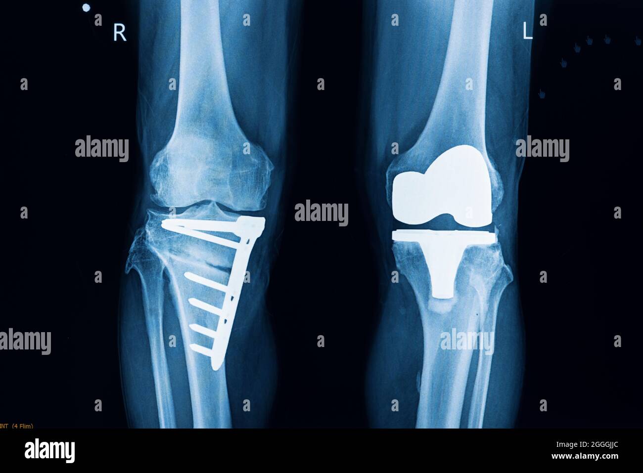 X-ray film of a patient after total left knee replacement surgery and plate and screws fixation of fractured right tibia. TKA operation and knee prost Stock Photo