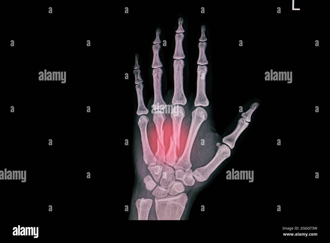 Hand xray showing closed fracture third and forth metacarpal bones. Stock Photo