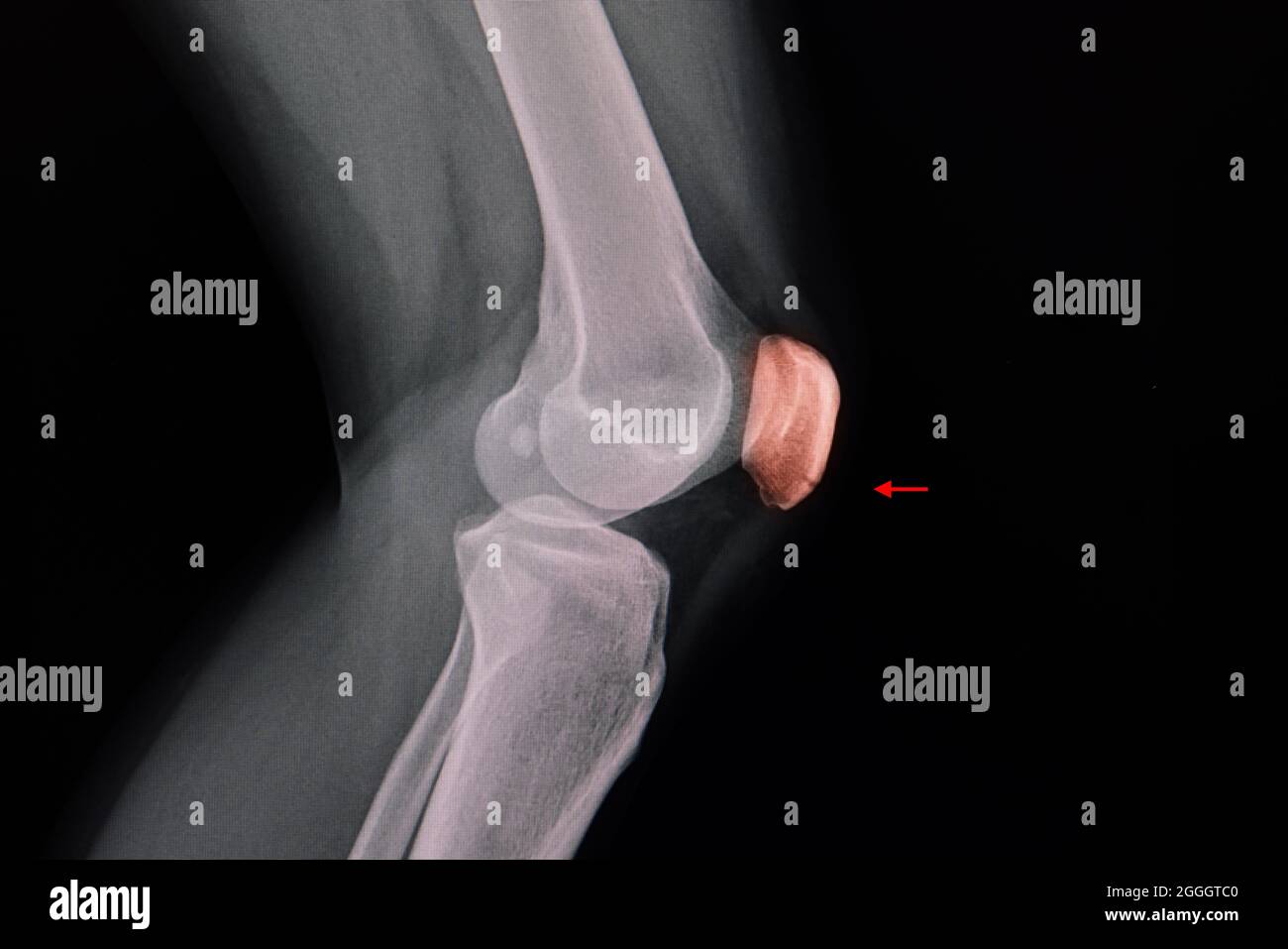 Knee xray of a patient showing a lucent line at lower part of the patella with linear non-displaced fracture of the patella and left knee effusion. Stock Photo