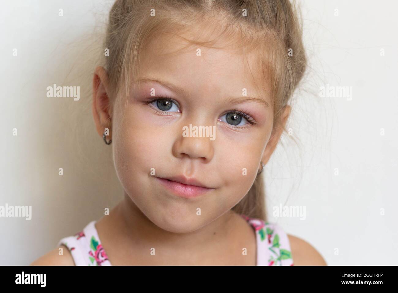 Portrait of caucasian little girl of five years old with swelling eyes