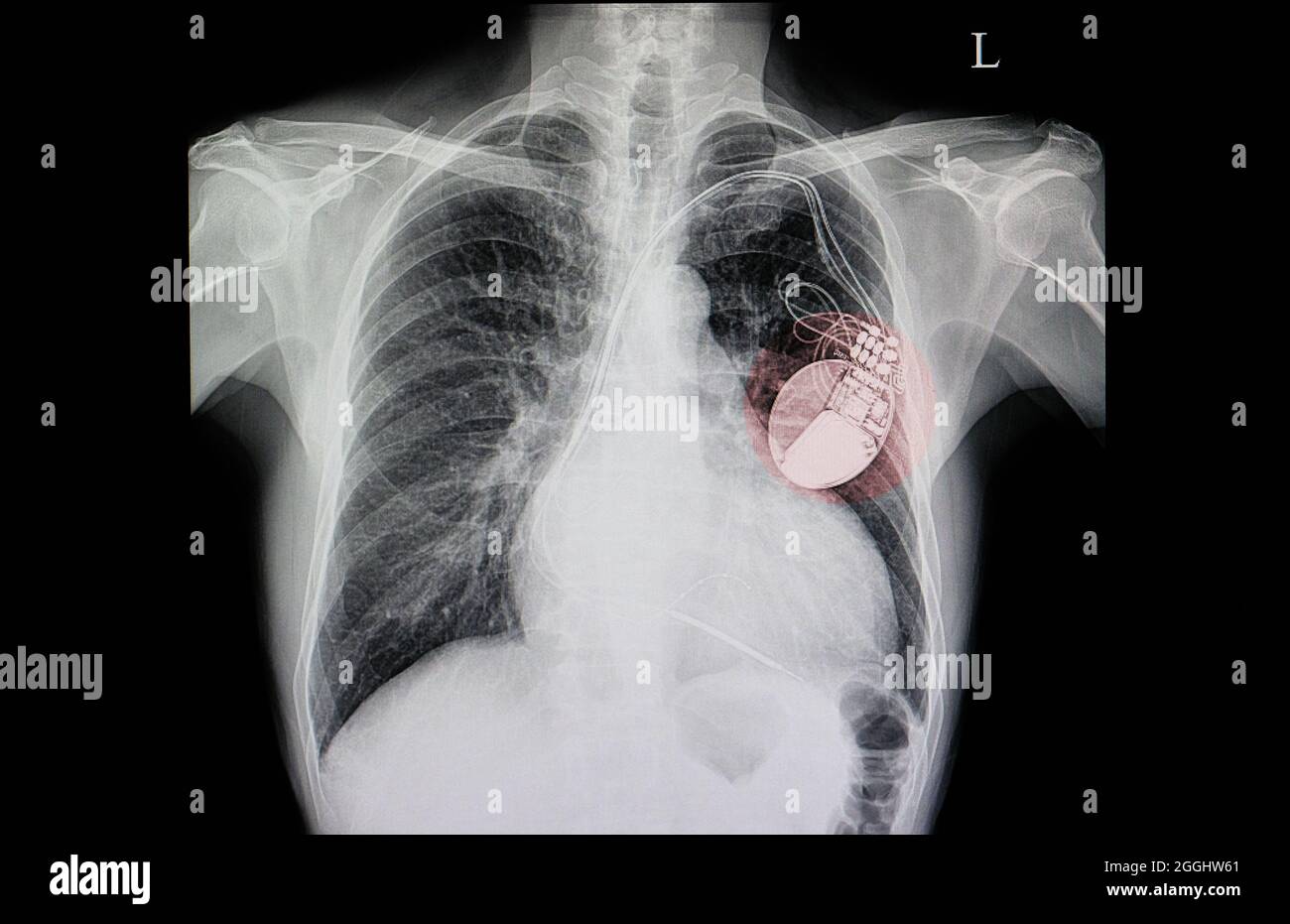 A chest xray film of a patient with cardiac pacemaker, also with congestive heart and cardiomegaly Stock Photo
