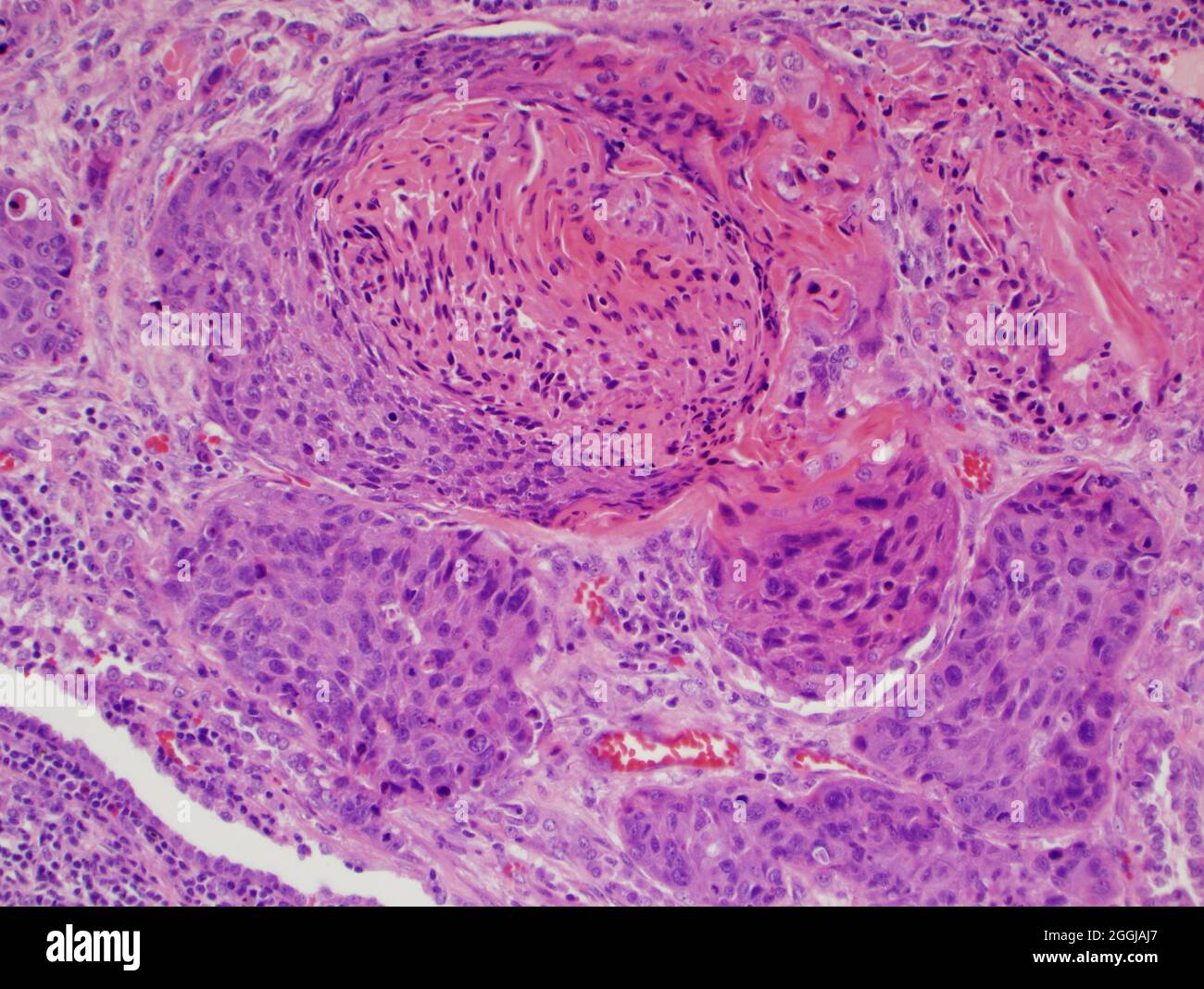 Lung cancer : pulmonary keratinizing squamous cell carcinoma associated with tobbaco use seen under microscope at 400x magnification. Stock Photo