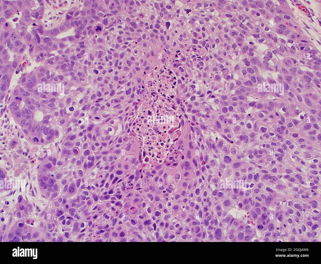 Lung cancer : pulmonary keratinizing squamous cell carcinoma associated with tobbaco use seen under microscope at 400x magnification. Stock Photo